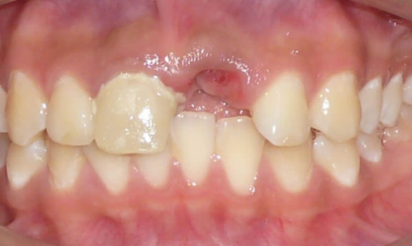 Dimplante-central-y-corona-en-diente-central-1