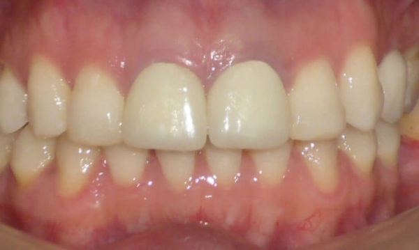 implante-central-y-corona-en-diente-central-3