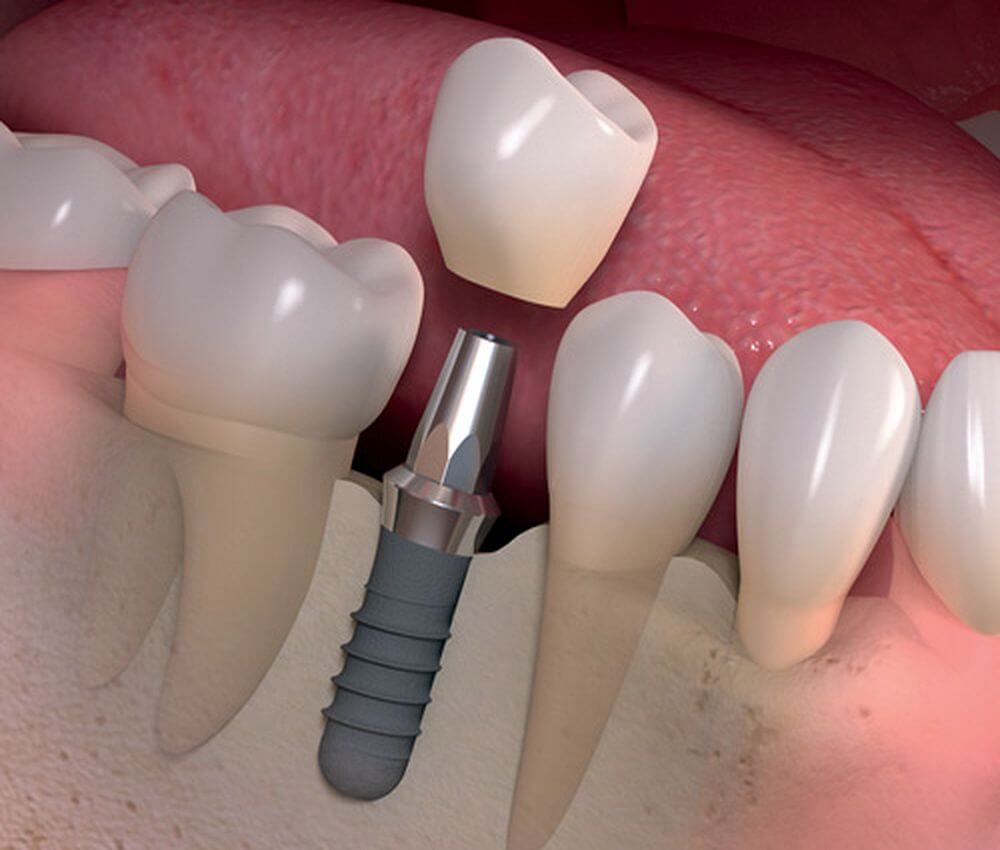 implantologia-oral